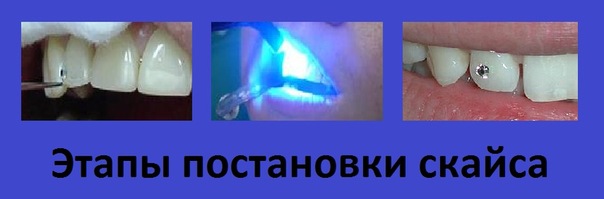 Установка скайсов на зубы что это такое Установка скайсов на зубы что это такое