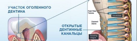 Немикробное поражение эмали и дентина