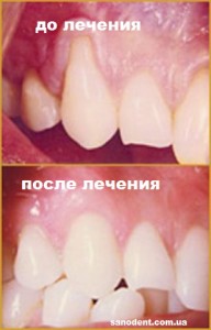 Как удалить акриловую краску Как снять напряжение в голове и теле при неврозе: постоянное
