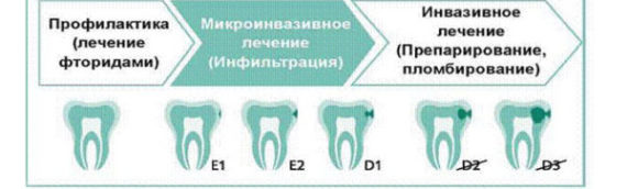 ICON — лечение кариеса без бормашины.