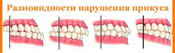 Нарушение прикуса. Виды неправильного прикуса. Лечение и профилактика патологий прикуса.