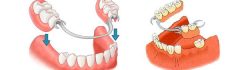 съемные протезы зубов, бюгельные