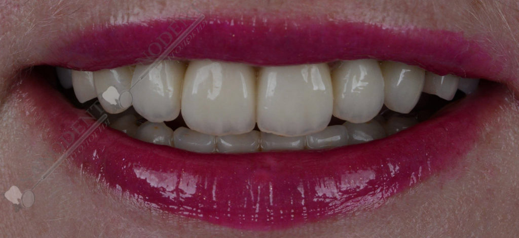 безметалловые коронки зубов