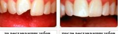 Эстетическая реставрация зубов до и после
