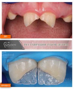 реставрация зубов ребенку Харьков