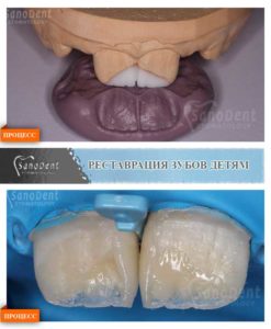 лечить зубы детям Харьков