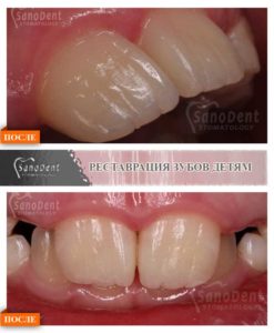 художественная реставрация зубов детям