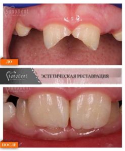 реставрация зубов ребенку фото до и после