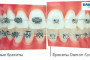 брекеты дэймон, damon брекет-система