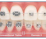 брекеты damon харьков цена