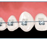 брекеты demon харьков цена, брекет-система даймон