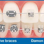 брекеты damon харьков цена