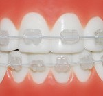 сапфировые брекеты Харьков