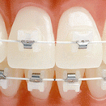 керамические брекеты Харьков