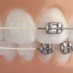керамические брекеты Харьков, металлические брекеты