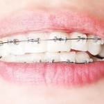 сапфировые брекеты, брекет-система сапфировая