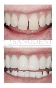 закрытие диастемы с помощью прямых виниров