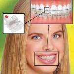 сапфировая брекет система