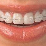 Сапфировые брекеты, улыбка с брекетами