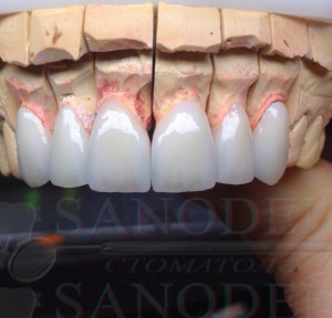 полные виниры в Харькове, керамические виниры