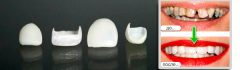голливудские виниры на зубы, до и после