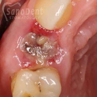 Воспаление десен после чистки зубов