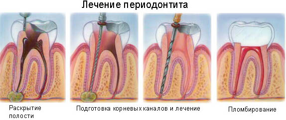 Лечение пародонтита современными средствами в Москве — Стоматология «Все свои!» — официальный сайт