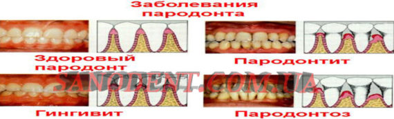 Пародонтит III стадии (запущенная или тяжелая форма): подробности о лечении