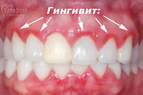 Лечение при термическом ожоге слизистой рта (десны) - Стоматология Smile