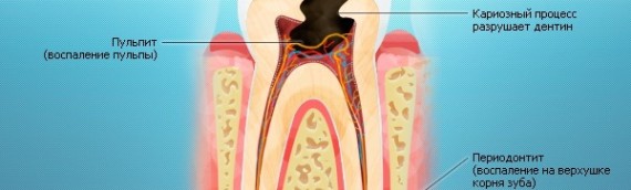 Симптомы: как диагностировать кариес зубов?