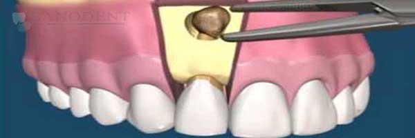 Лечение гранулемы, кисты и флюса зуба.