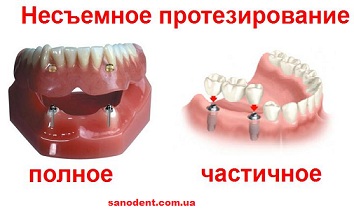 протезирование зубов Томск Украинский