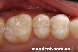 герметизация фиссур