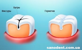 как герметизируют зубы