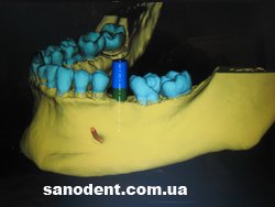 3d модель для имплантации зубов