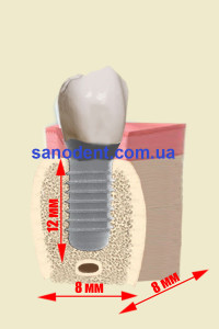 имплантация зубов