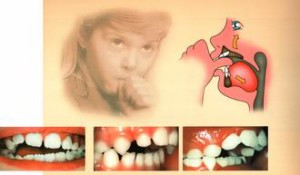 пагубная привычка сосать палец у ребенка