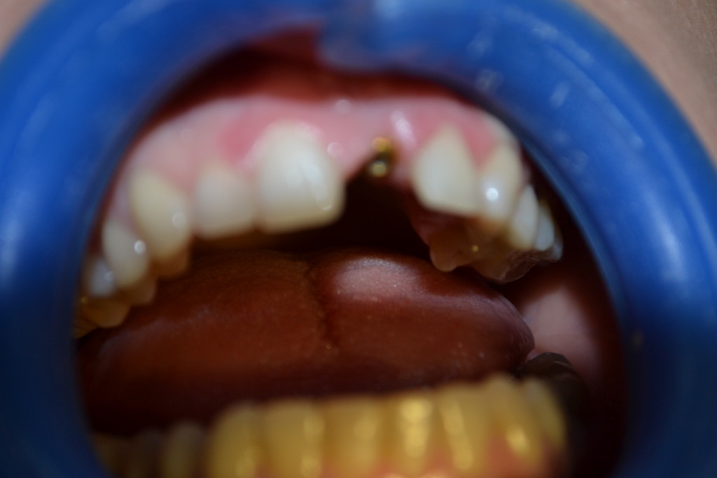 Протезирование зубов в Харькове