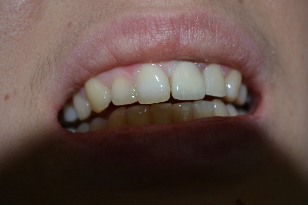 безметалловая керамика е-макс, протезирование зубов Харьков