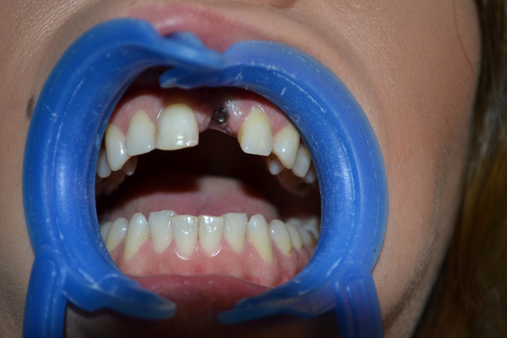 успешная имплантация зуба