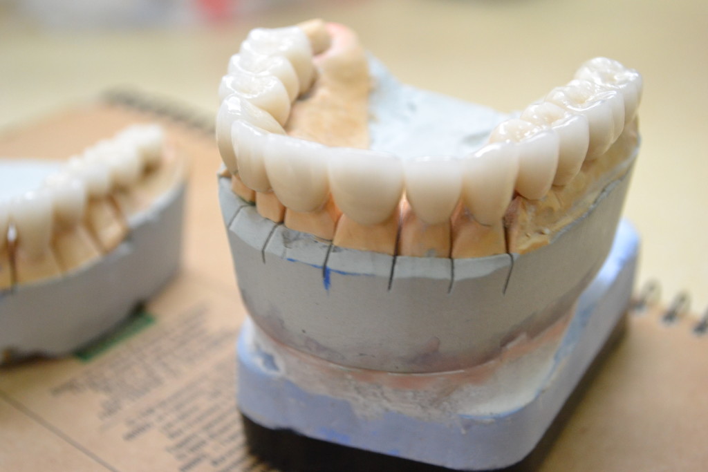 коронки на модели стоматология Санодент Харьков