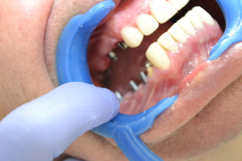 имплантация зубов