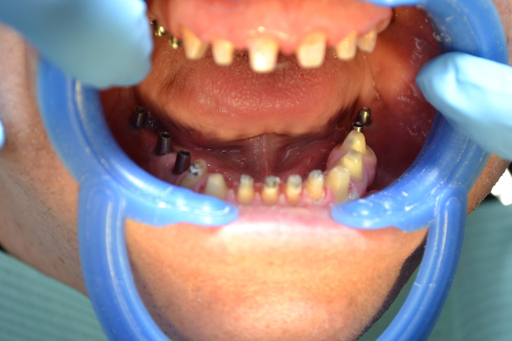 препарация зубов под протезирование