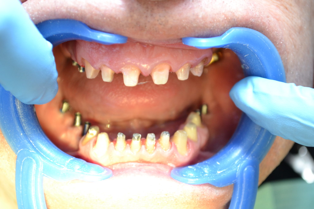 подготовка под протезирование зубов