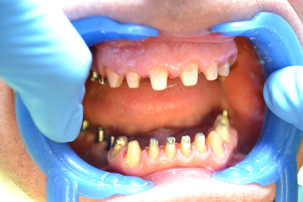 установка абатментов на импланты