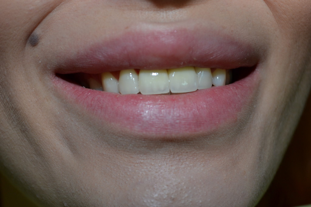 после протезирования зубов в Харькове