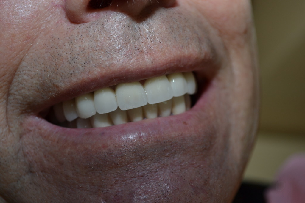 после лечения и имплантации