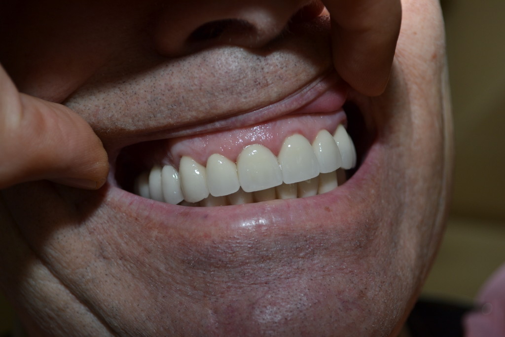 десневое прилегание керамических коронок