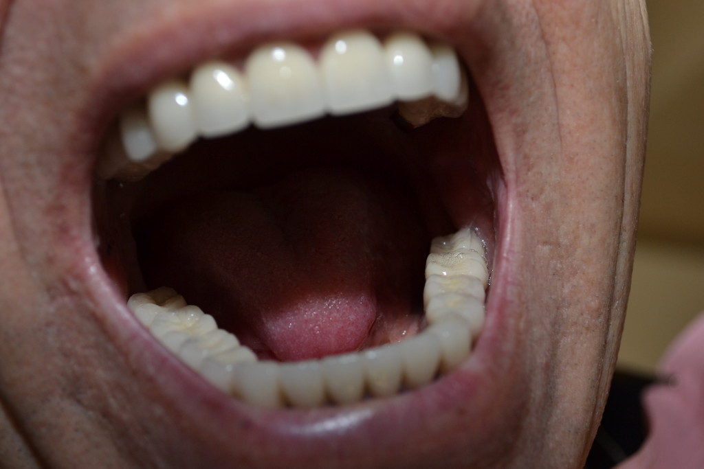 готовая работа по протезированию