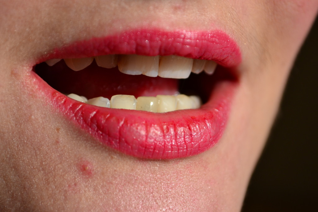 голливудские виниры Харьков